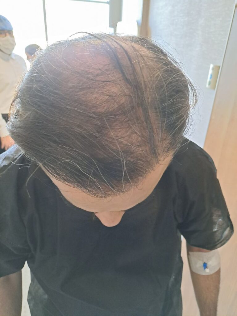 Billede 29 fra HÅRTRANSPLANTATION 2