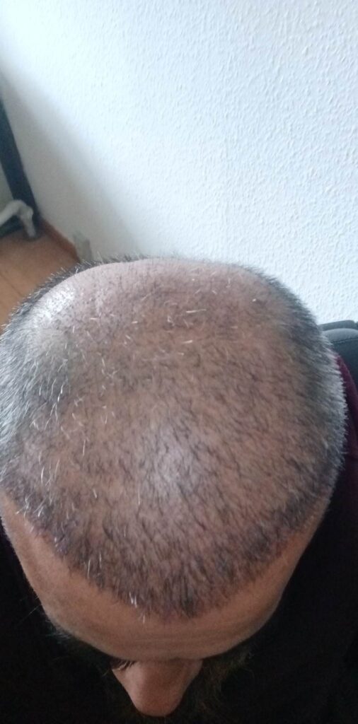 Billede 31 fra HÅRTRANSPLANTATION 2