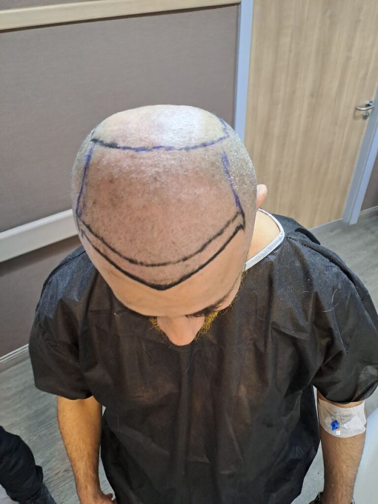 Billede 30 fra HÅRTRANSPLANTATION 2