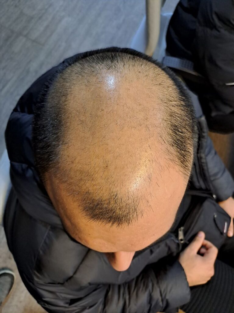 Billede 32 fra HÅRTRANSPLANTATION 2