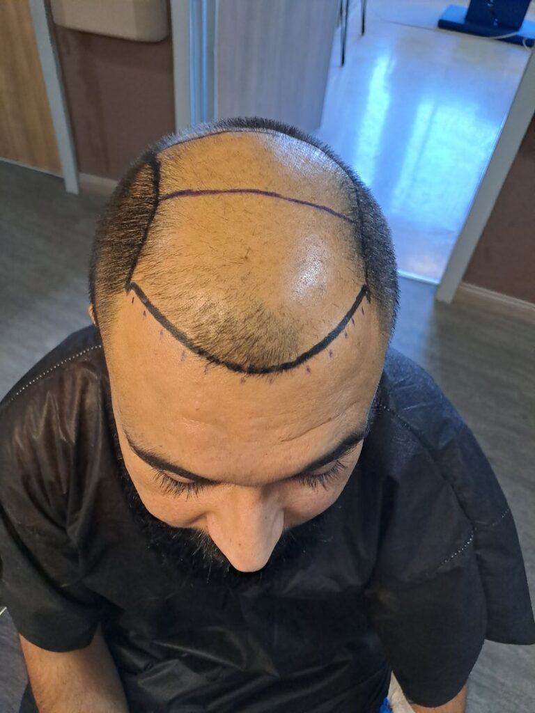 Billede 33 fra HÅRTRANSPLANTATION 2