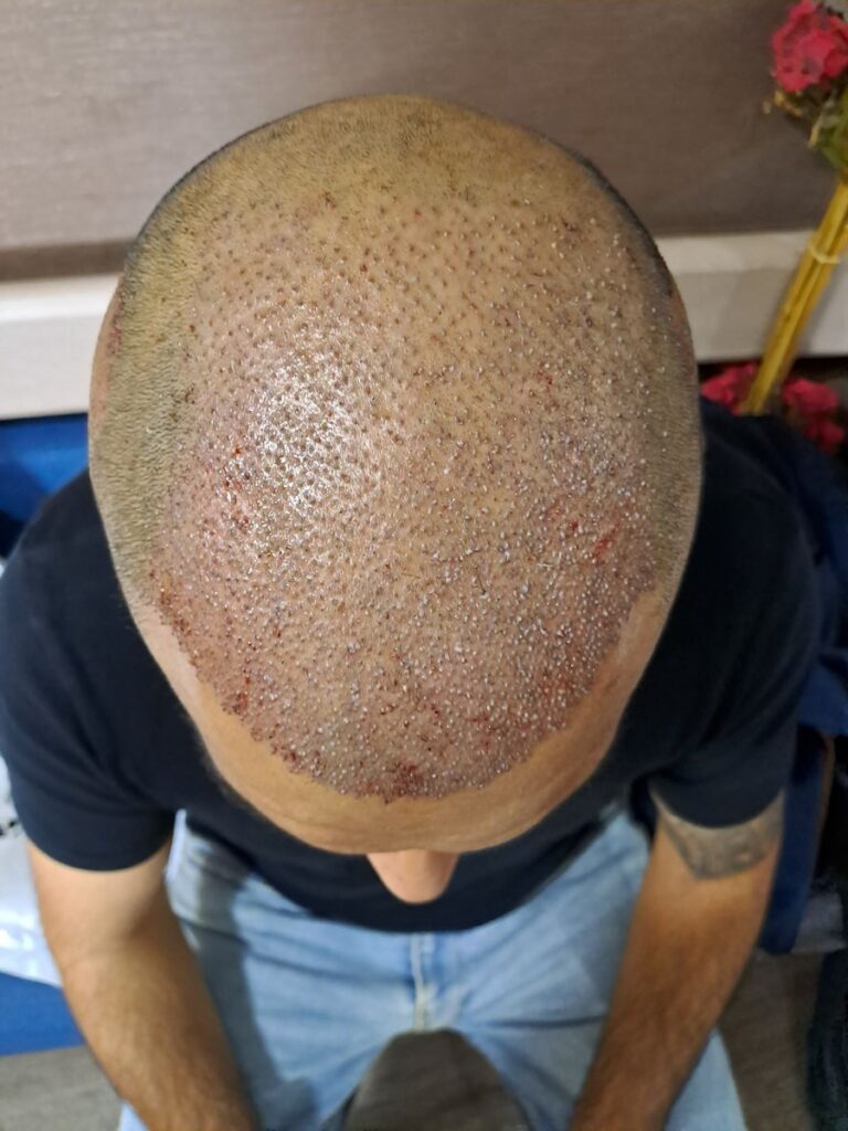 Billede 34 fra HÅRTRANSPLANTATION 2