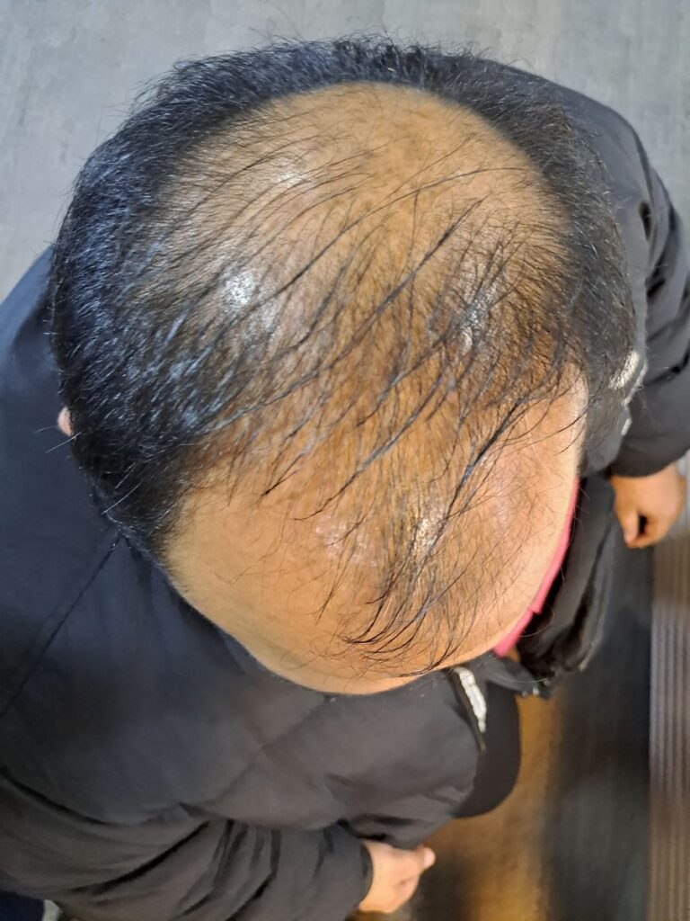 Billede 26 fra HÅRTRANSPLANTATION 2