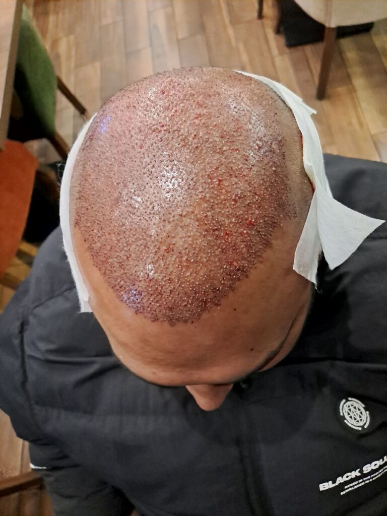 Billede 27 fra HÅRTRANSPLANTATION 2