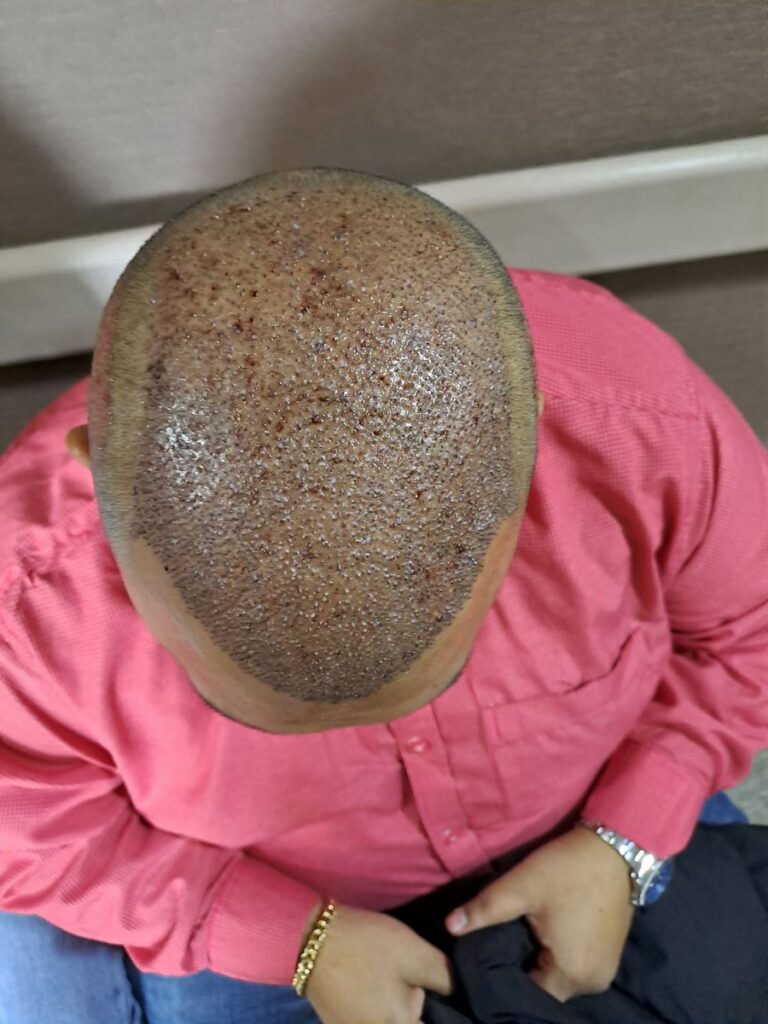 Billede 28 fra HÅRTRANSPLANTATION 2