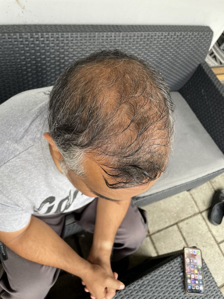 HÅRTRANSPLANTATION + TÆNDER 1
