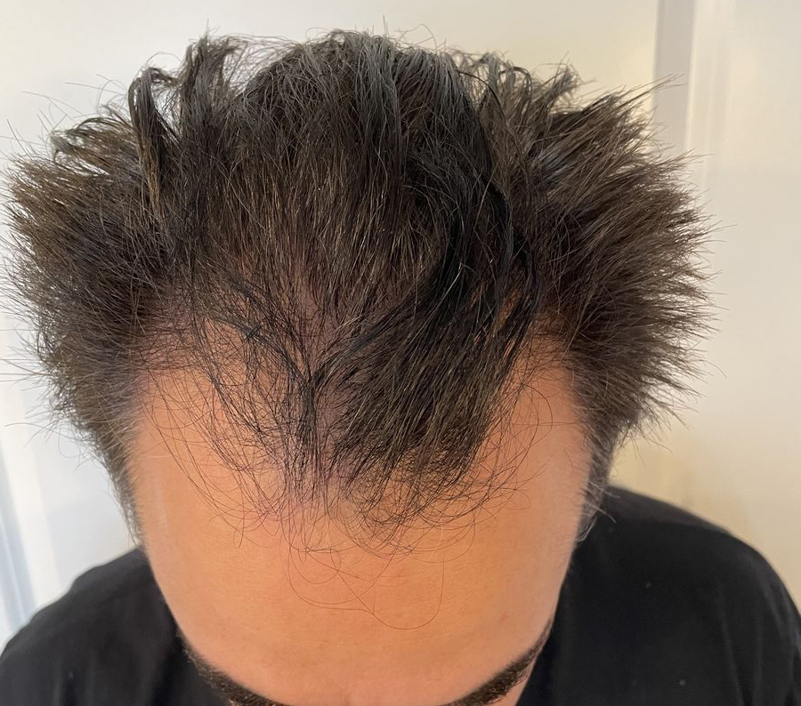 Billede 4 fra HÅRTRANSPLANTATION + TÆNDER 1