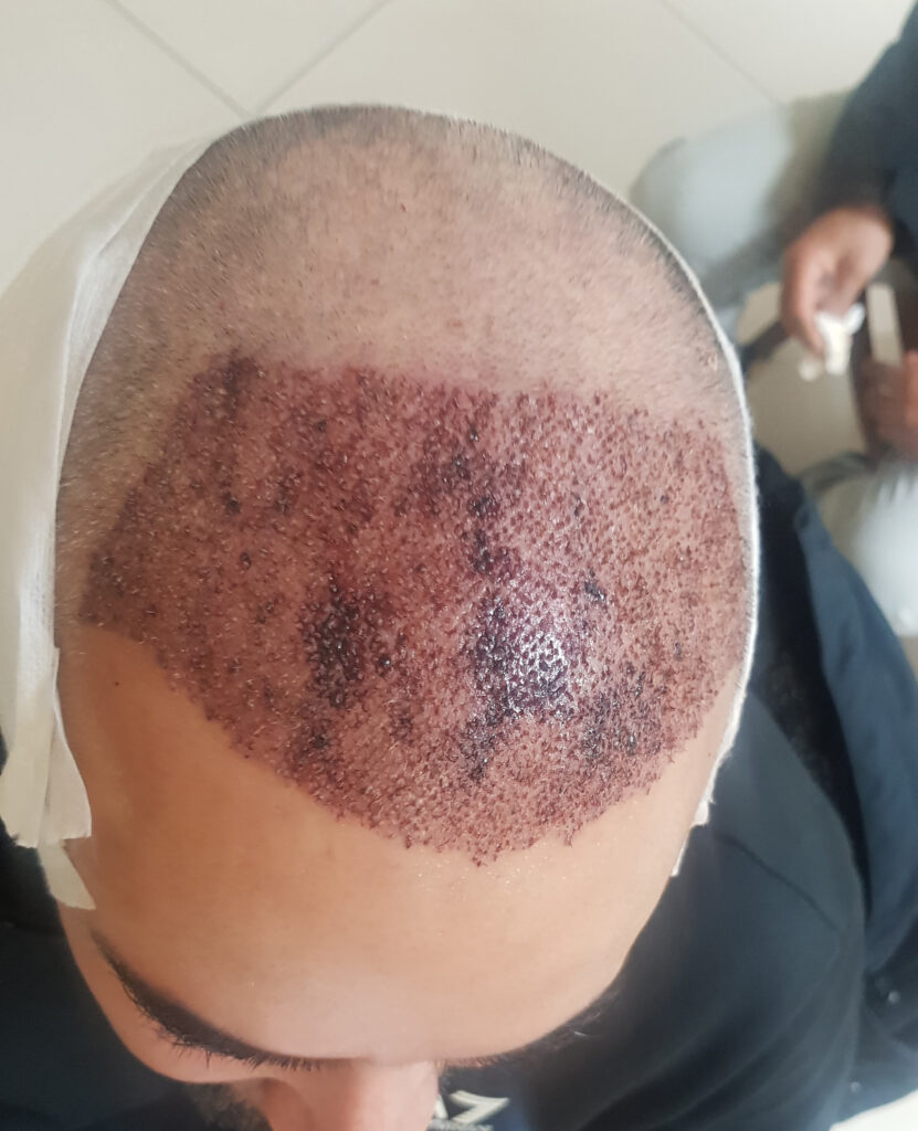 Billede 5 fra HÅRTRANSPLANTATION + TÆNDER 1