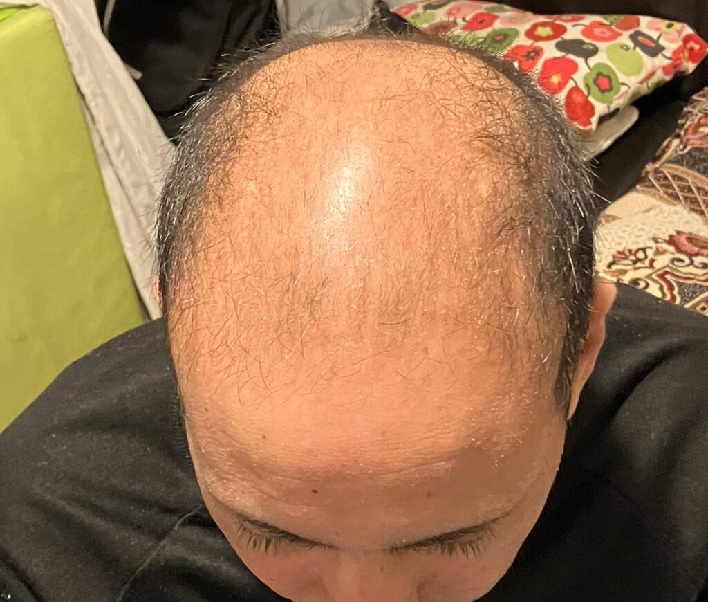Billede 7 fra HÅRTRANSPLANTATION + TÆNDER 1